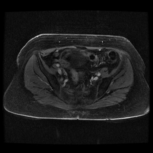 Cervical carcinoma (Radiopaedia 70924-81132 Axial T1 C+ fat sat 240).jpg