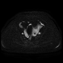 Cervical carcinoma (Radiopaedia 85405-101028 Axial DWI 54).jpg