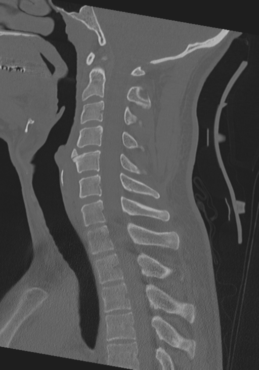 Cervical intercalary bone (Radiopaedia 35211-36748 Sagittal bone window 39).png