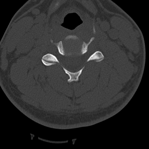 Cervical schwannoma (Radiopaedia 57979-64974 Axial bone window 26).png