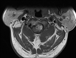 File:Cervical spinal neurofibroma in a patient with NF1 (Radiopaedia 58344-65465 Axial T1 4).jpg