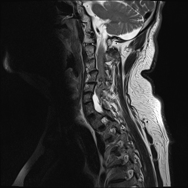 File:Cervical spinal neurofibroma in a patient with NF1 (Radiopaedia 58344-65465 Sagittal T2 3).jpg