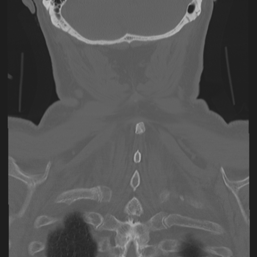 Cervical spine fracture in the setting of ankylosis (Radiopaedia 37038-38715 Axial bone window 1).png