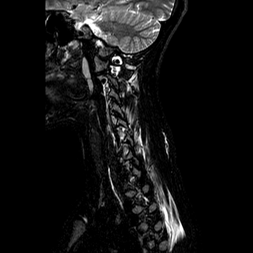 File:Cervical spine posterior ligamentous complex rupture (Radiopaedia 63486-72103 Sagittal STIR 2).jpg