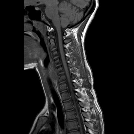 File:Cervical spine posterior ligamentous complex rupture (Radiopaedia 63486-72103 Sagittal T1 8).jpg