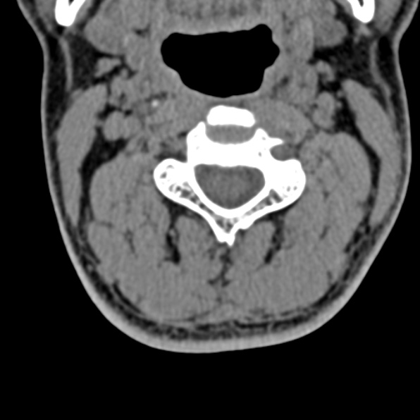 Cervical spondylodiscitis (Radiopaedia 28057-29489 Axial non-contrast 31).jpg