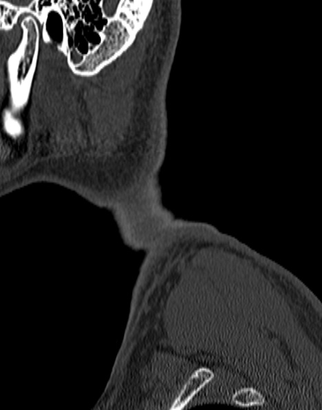 Cervical spondylodiscitis (Radiopaedia 28057-29489 Sagittal bone window 4).jpg