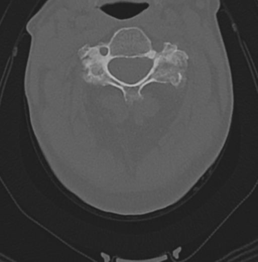 File:Cervical spondylolysis (Radiopaedia 49616-54811 Axial bone window 23).png