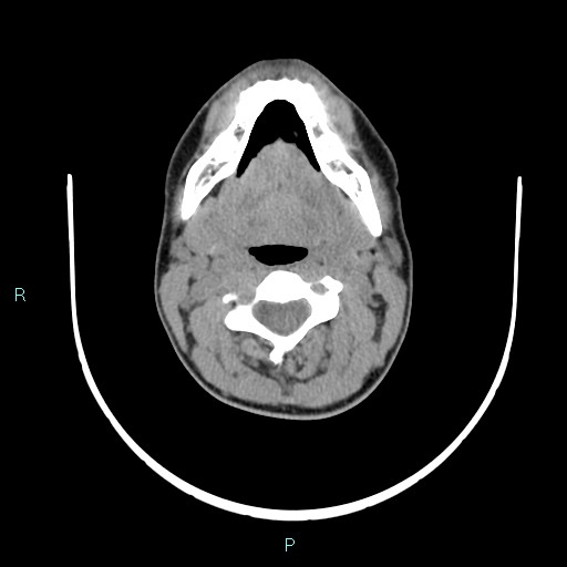Cervical thymic cyst (Radiopaedia 88632-105335 Axial non-contrast 77).jpg