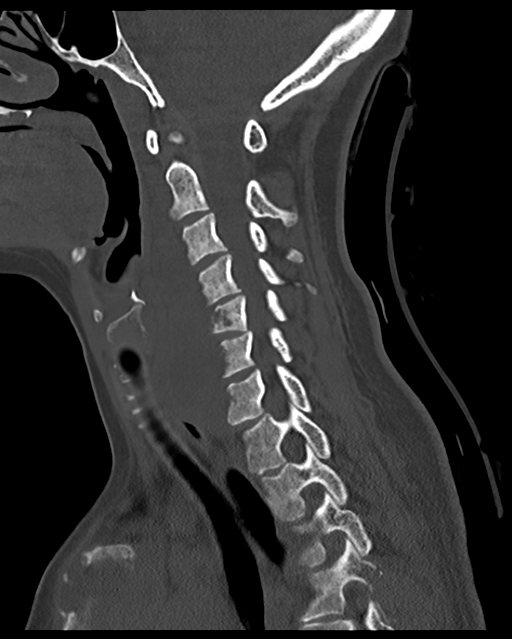 Cervical tuberculous spondylitis (Radiopaedia 39149-41365 Sagittal bone window 40).png