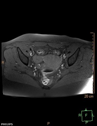 File:Cesarian scar endometriosis (Radiopaedia 68495-78066 Axial T1 fat sat 13).jpg