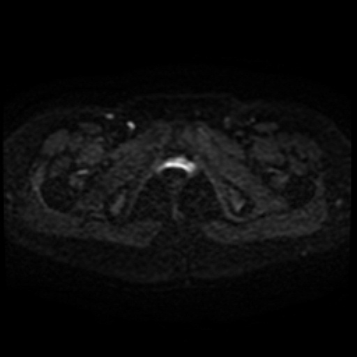 Cesarian section scar endometriosis (Radiopaedia 66520-75799 Axial DWI 48).jpg