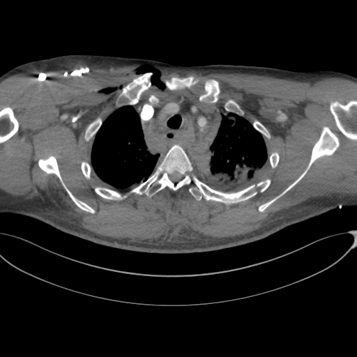 File:Chest multitrauma - aortic injury (Radiopaedia 34708-36147 A 60).png