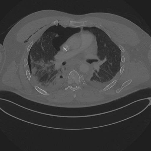 Chest multitrauma - aortic injury (Radiopaedia 34708-36147 Axial bone window 142).png