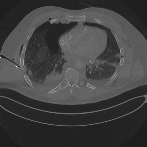 Chest multitrauma - aortic injury (Radiopaedia 34708-36147 Axial bone window 192).png