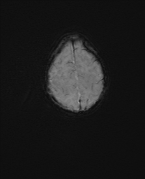Chiari III malformation with occipital encephalocele (Radiopaedia 79446-92559 Axial SWI 53).jpg