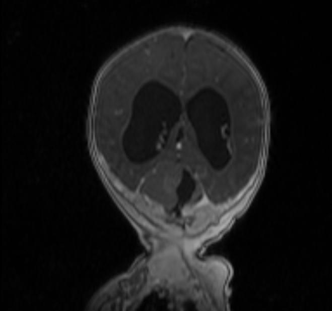 Chiari III malformation with occipital encephalocele (Radiopaedia 79446-92559 Coronal T1 C+ mpr 30).jpg