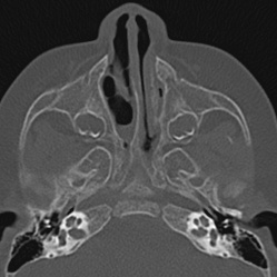 Choanal atresia (Radiopaedia 88525-105975 Axial bone window 31).jpg