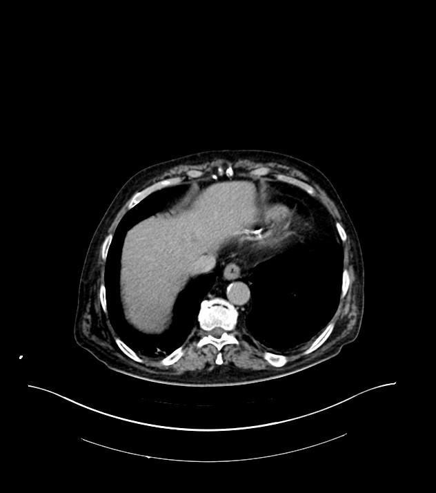 Cholangiocarcinoma with cerebral metastases (Radiopaedia 83519-98629 Axial C+ delayed 11).jpg
