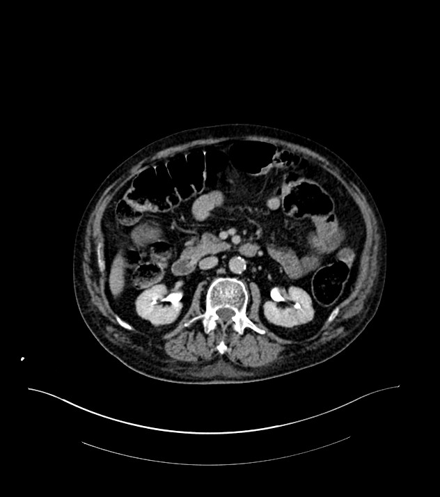 Cholangiocarcinoma with cerebral metastases (Radiopaedia 83519-98629 Axial C+ delayed 48).jpg