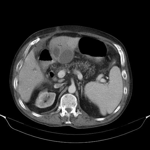 File:Cholangitis and abscess formation in a patient with cholangiocarcinoma (Radiopaedia 21194-21100 A 18).jpg