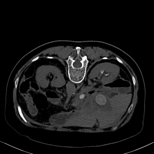 File:Cholecystitis - obstructive choledocholitiasis (CT intravenous cholangiography) (Radiopaedia 43966-47479 Axial 12).png