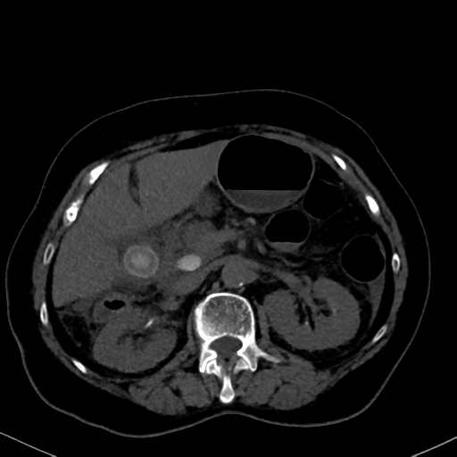 File:Cholecystitis - obstructive choledocholitiasis (CT intravenous cholangiography) (Radiopaedia 43966-47479 Axial 94).png