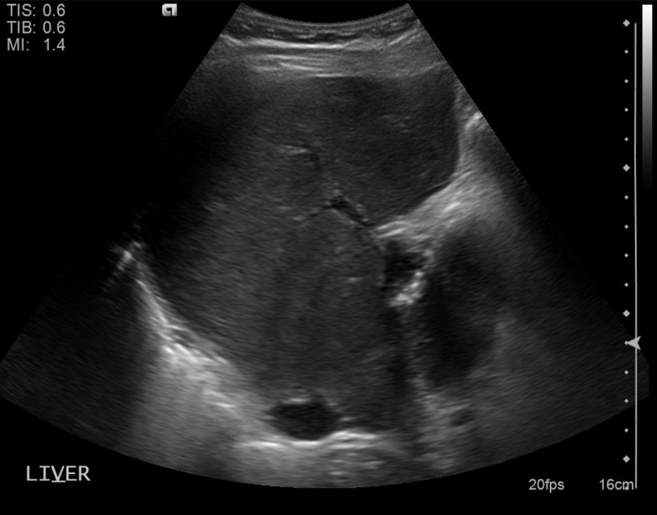 File:Cholecystitis - perforated gallbladder (Radiopaedia 57038-63913 A 4).jpg