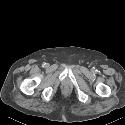 File:Choledocholithiasis and gastric polyp (Radiopaedia 48856-53895 Axial non-contrast 91).png