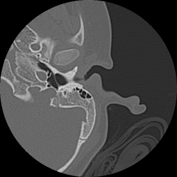 Cholesteatoma (Radiopaedia 73023-83750 Axial Left ear 17).jpg