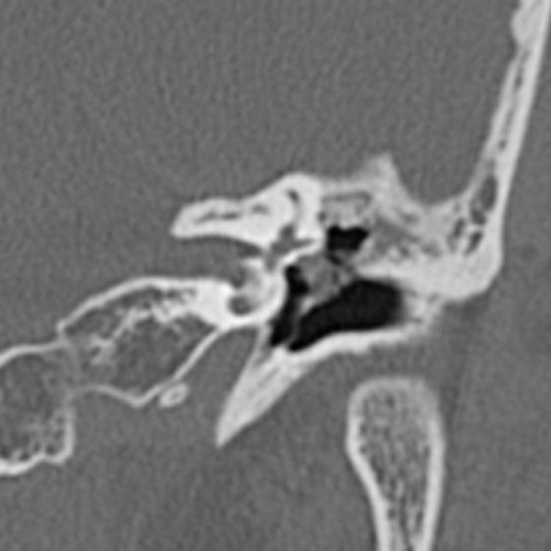 File:Cholesteatoma (Radiopaedia 9408-10093 Coronal bone window 9).jpg