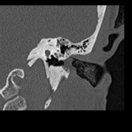 File:Cholesteatoma of the external ear (Radiopaedia 16540-16225 Coronal bone window 14).jpg
