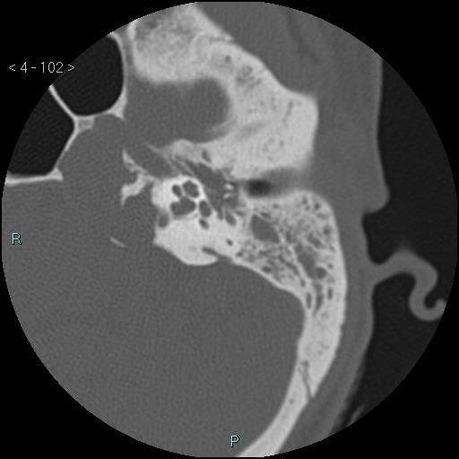 Cholesterol granuloma of the petrous apex (Radiopaedia 64358-73141 Axial bone window 49).jpg