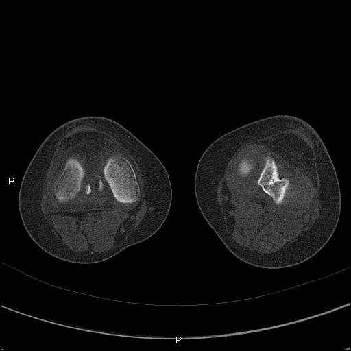 File:Chondroblastoma (Radiopaedia 62721-71030 Axial bone window 35).jpg