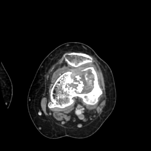 Chondrosarcoma - femur (Radiopaedia 64187-72954 Axial with contrast 42).jpg