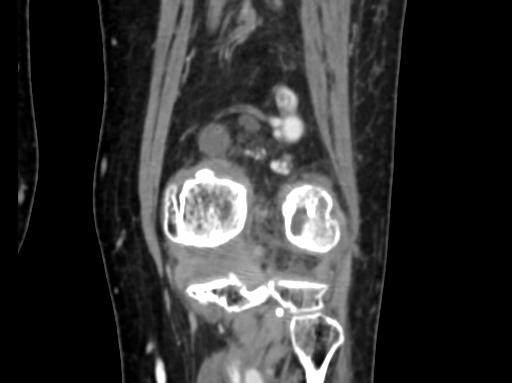 Chondrosarcoma - femur (Radiopaedia 64187-72954 C 44).jpg