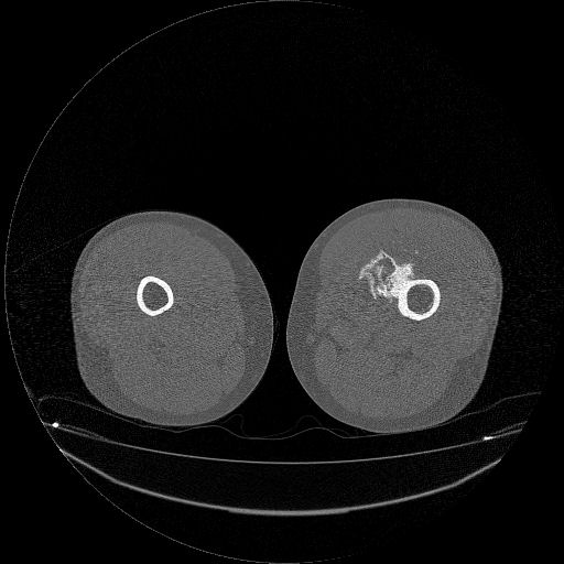 File:Chondrosarcoma arising from exostosis (Radiopaedia 59996-67507 Axial bone window 10).jpg