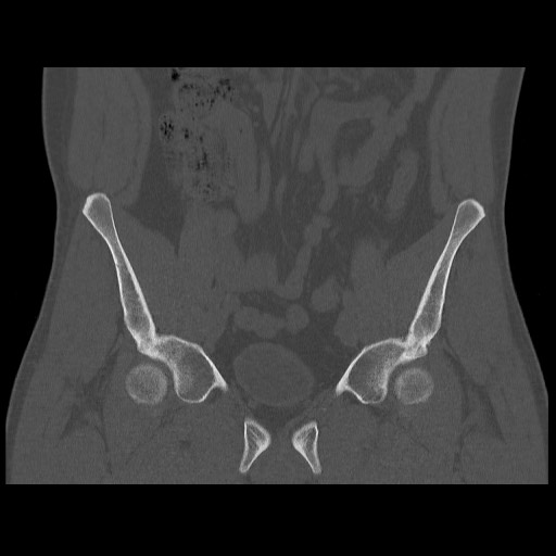 Chondrosarcoma of iliac wing (Radiopaedia 63861-72599 Coronal bone window 44).jpg
