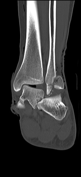 Chopart fracture (Radiopaedia 35347-36851 Coronal bone window 30).jpg