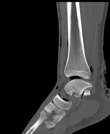 Chopart fracture (Radiopaedia 35347-36851 Sagittal bone window 31).jpg