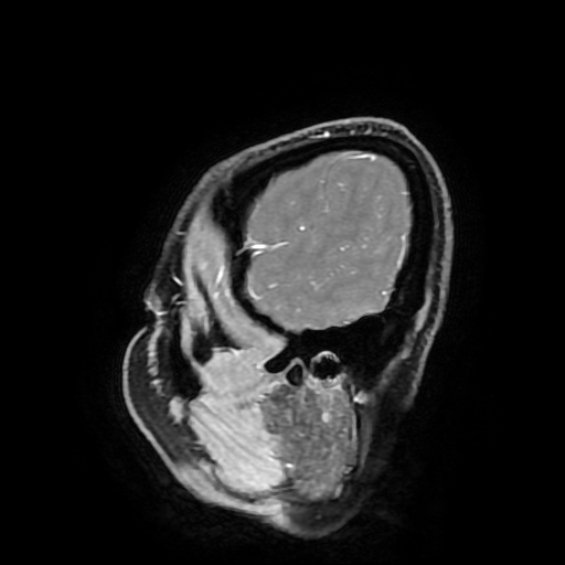 Chordoid glioma of third ventricle (Radiopaedia 91612-109340 F 34).jpg