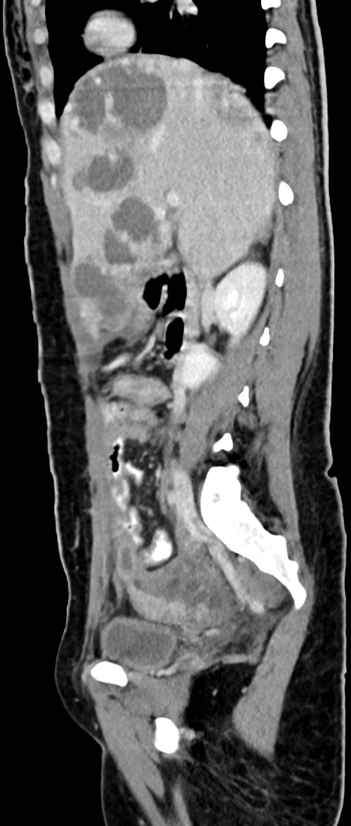 Choriocarcinoma liver metastases (Radiopaedia 74768-85766 C 114).jpg
