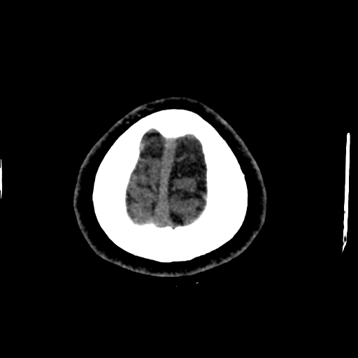 Choroid plexus xanthogranulomas (Radiopaedia 51621-57408 Axial non-contrast 111).jpg