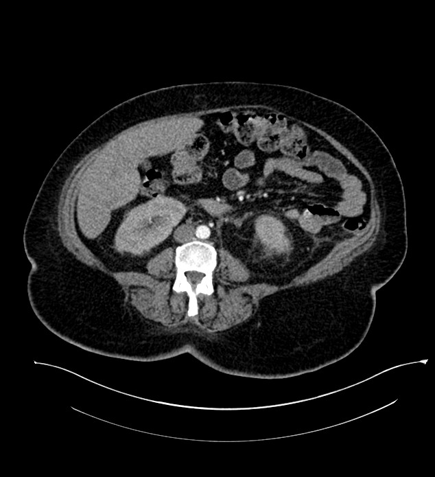 Chromophobe renal cell carcinoma (Radiopaedia 84239-99519 B 67).jpg