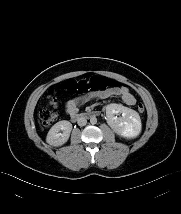Chromophobe renal cell carcinoma (Radiopaedia 84255-99542 H 21).jpg