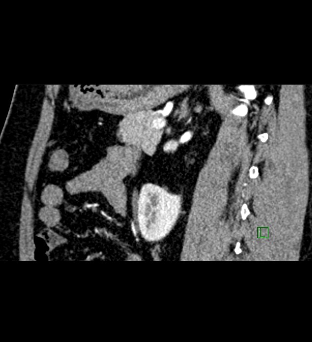 Chromophobe renal cell carcinoma (Radiopaedia 84286-99573 F 65).jpg