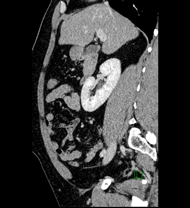 Chromophobe renal cell carcinoma (Radiopaedia 84286-99573 I 117).jpg