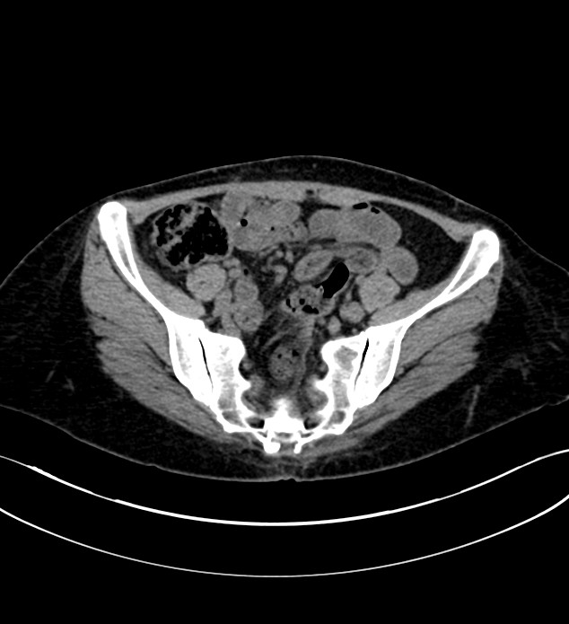 Chromophobe renal cell carcinoma (Radiopaedia 84290-99582 Axial non-contrast 114).jpg