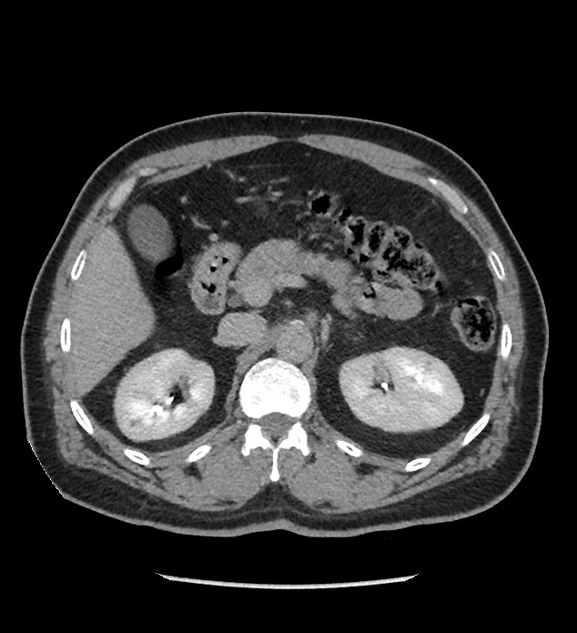 Chromophobe renal cell carcinoma (Radiopaedia 86879-103083 D 47).jpg