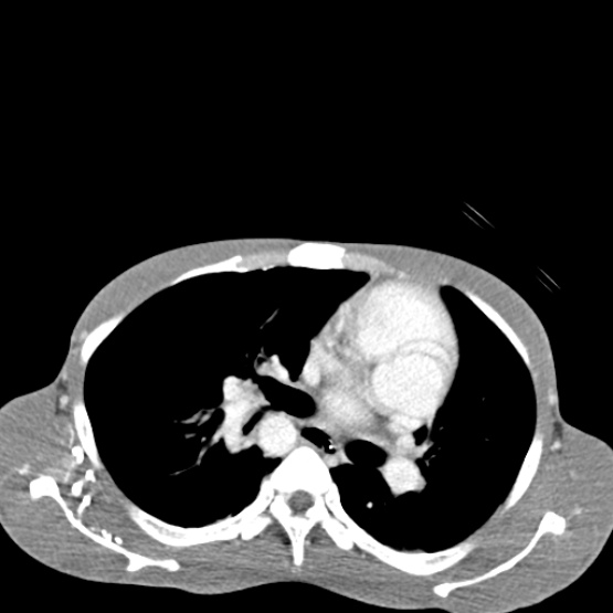 File:Chronic large bowel pseudo-obstruction (Radiopaedia 43181-46492 A 9).jpg